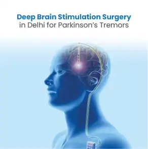 Deep Brain Stimulation Surgery in Delhi for Parkinson’s Tremors